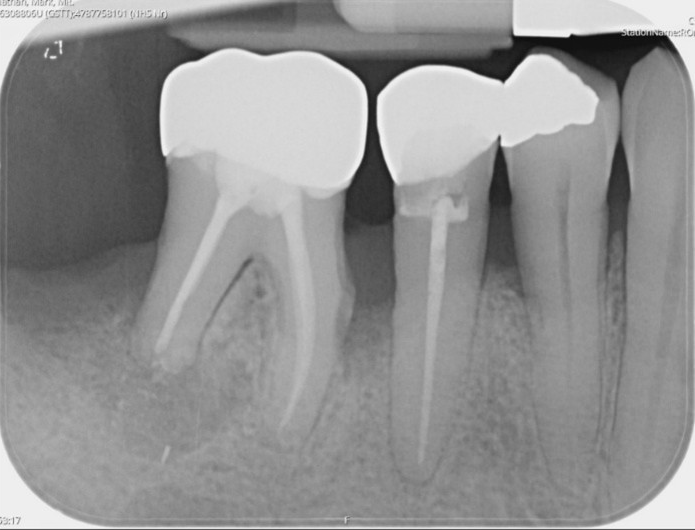 Multi-disciplinary treatment - Post-operative X-ray